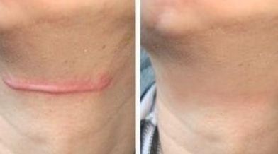 上海哪家醫(yī)院的玻尿酸鼻子效果最好？