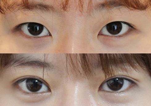 2023南昌無(wú)痕水波拉皮正規(guī)專家榜單前10名(陳奕霏、楊存昌、戴文燦技術(shù)口碑在線)