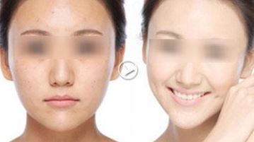 廣州哪家醫(yī)院去黑頭好？揭秘廣州專業(yè)祛黑頭效果最佳的醫(yī)療機構(gòu)