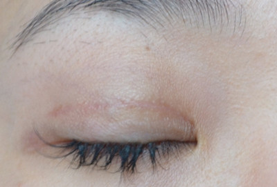 2023上海嗨體去抬頭紋排名前十的專家(張芝演、董佳生、李鎬均這些正規(guī)專家推薦給你)