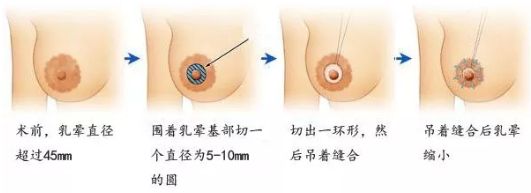 在哈爾濱做除皺哪家醫(yī)院好？選擇專業(yè)除皺醫(yī)生，享受高質(zhì)量護理服務