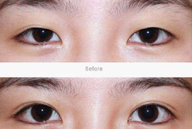 上海雙眼皮手術(shù)哪家醫(yī)院好？選擇哪家醫(yī)院最關(guān)鍵