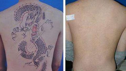 怎樣修復(fù)鄭荃疤痕，讓人滿(mǎn)意？