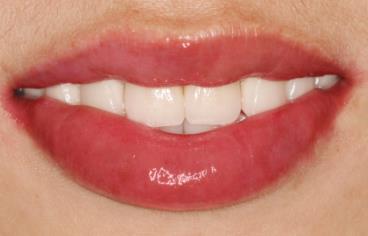 2023義烏點(diǎn)陣激光祛額頭紋排行前10強(qiáng)的專家(李超、曹長(zhǎng)清、張小紅本地人尤為認(rèn)可)