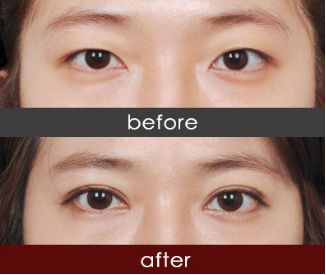 恩施市哪家醫(yī)院注射除皺針效果好推薦？