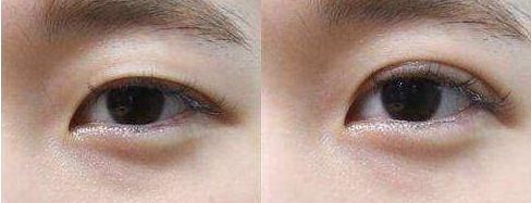 寧波市眼袋手術(shù)哪家醫(yī)院好？