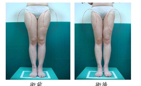 杭州做埋線哪家醫(yī)院好？選擇正規(guī)專業(yè)的醫(yī)療機(jī)構(gòu)，安全可靠！