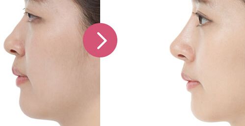 廣州哪家醫(yī)院眼部整形效果好，專業(yè)醫(yī)院推薦