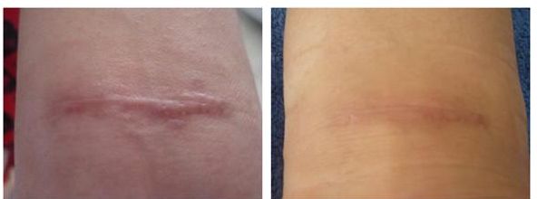 廣州治疤痕醫(yī)院專家推薦，哪家治疤痕效果好？