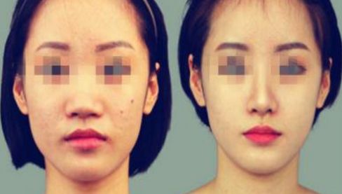 養(yǎng)成美鼻的6個關(guān)鍵步驟，完美修復(fù)效果在您的掌握！