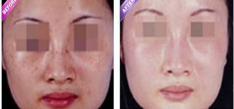 激光縮陰是否會(huì)導(dǎo)致副作用？找到安全有效的解決方法