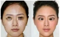 腹部吸脂過(guò)程有無(wú)疼痛，電切無(wú)感手術(shù)安全高效