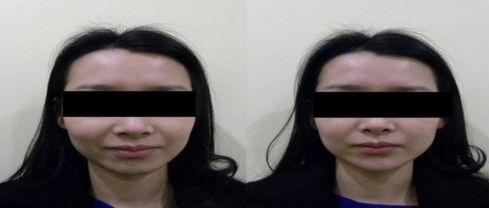 上瞼下垂手術(shù)的關(guān)鍵要素及事前事后的注意事項(xiàng)