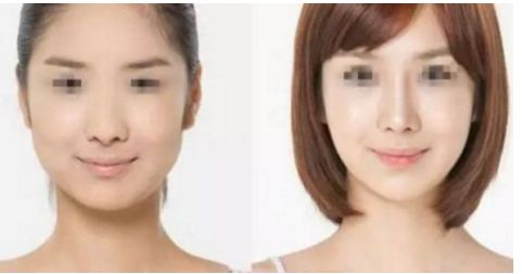威寧隆胸手術(shù)效果如何？術(shù)后持久無需擔(dān)心！