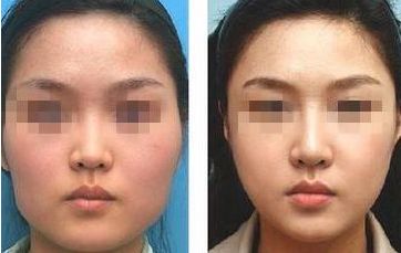 如何改善圓臉型，輕松塑造瓜子臉？五個有效技巧揭秘！