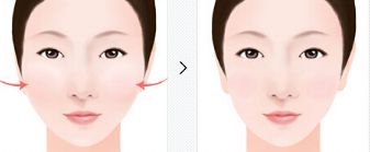 年輕人瘦臉手術(shù)不同等級全面對比