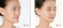 隆鼻手術(shù)平衡術(shù)：讓你的鼻子立體感更強