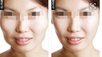 假體隆胸植入多久需要更換？
