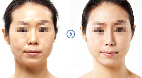 想要塑造完美鼻型？了解全肋骨隆鼻手術嗎？