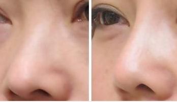 湖南雙眼皮修復(fù)，成功率備受矚目
