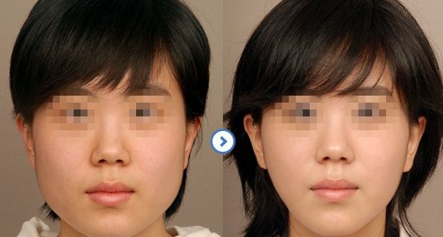 鼻部假體整形：探尋安全有效的修復(fù)方法