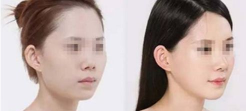 假體隆鼻手術(shù)帶來正自然效果，狀似真實鼻形