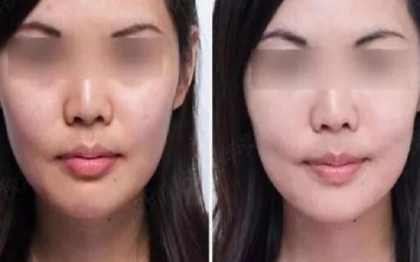 35歲采用超聲療程好還是熱瑪吉更好？匿名評測揭秘！