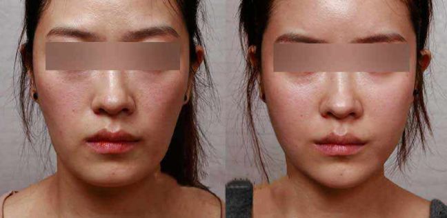 眼袋手術(shù)后效果持續(xù)多久？解析專家分享