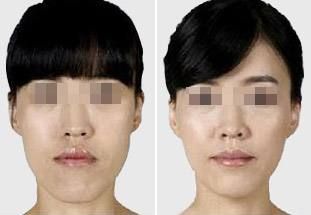 肋骨隆鼻后的面部消腫需要多長時間？消腫小竅門曝光！
