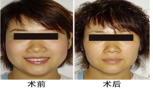 咬肌切除手術(shù)后對面部功能是否會受影響？