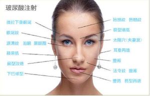 十堰肉毒素注射價格查詢