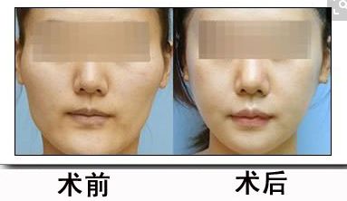 鼻骨矯正對(duì)外貌有何影響？矯正費(fèi)用合理嗎？