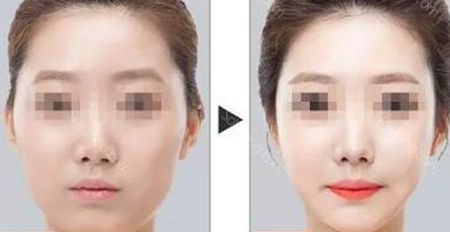 陰道緊實(shí)手術(shù)的疼痛程度到底如何？