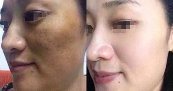 淚溝填充：熊貓針VS膠原蛋白，手術(shù)過程與注意事項(xiàng)解析