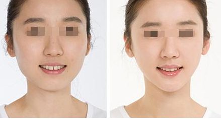 鼻整形手術價格分析：效果原理講解，術后注意事項，不良反應剖析