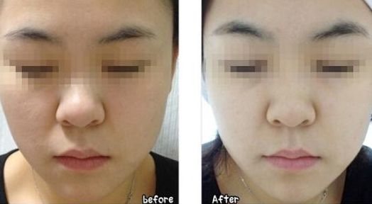 韓式微創(chuàng)無痕處女膜修復(fù)的效果如何？