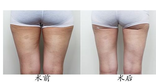 體驗(yàn)光子嫩膚，解密北京光子嫩膚價(jià)格