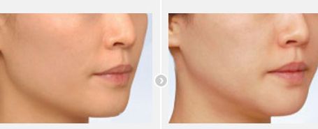 北京最受歡迎的雙眼皮修復(fù)醫(yī)生，多位滿意的患者推薦！