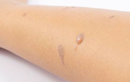 哈爾濱宋桂霞醫(yī)生為您解析雙眼皮手術(shù)的獨(dú)到體驗(yàn)