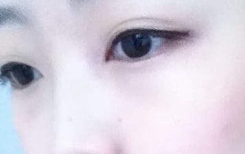 劉月麗醫(yī)生的雙眼皮修復技術在鄭大二附院備受矚目