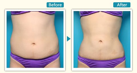 杭州市口碑較好的整形醫(yī)院有哪些？靜港、浙江省人民醫(yī)院、格萊美等入選推薦列表