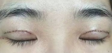 上海王會(huì)勇醫(yī)生鼻部整形案例分享：創(chuàng)新技術(shù)助您獲得完美鼻型！