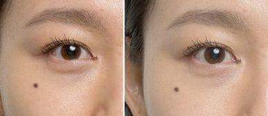 董玉林醫(yī)生的整形收費標準及隆胸案例分享