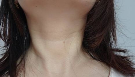 江華教授隆胸術(shù)，口碑與收費(fèi)詳解