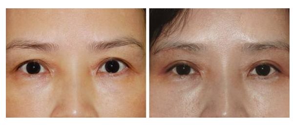 女生變成網(wǎng)紅臉需要多少投入？解析投資成本及效益