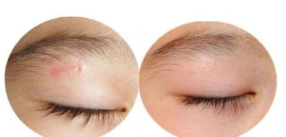 廣州曙光醫(yī)院雙眼皮手術手藝高超，名醫(yī)推薦！附真實案例！