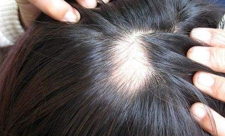 南京新生醫(yī)院植發(fā)效果如何？坐診專家簡介、詳細地址一覽