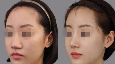 祛斑攻略：探秘激光去斑價(jià)格及術(shù)后護(hù)理要點(diǎn)