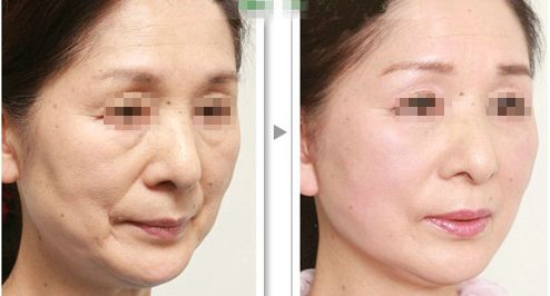 上海哪家磨骨醫(yī)院靠譜？華美、美聯(lián)臣、薇琳資歷雄厚值得信賴