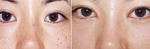 排名前五的廣醫(yī)二院雙眼皮醫(yī)生，價格參考2023